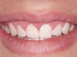 Cosmetic Periodontal Surgery - After